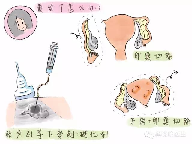 子宫内膜异位症——痛经的一种常见病因