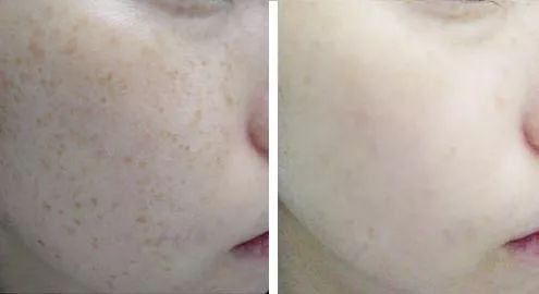 5个祛斑小妙招淡化晒斑雀斑痘印,痘印晒斑和疤痕用什么产品比较好