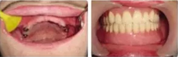 速看！11月起，这些新规实施，矫正牙齿、种植牙这些费用全免！