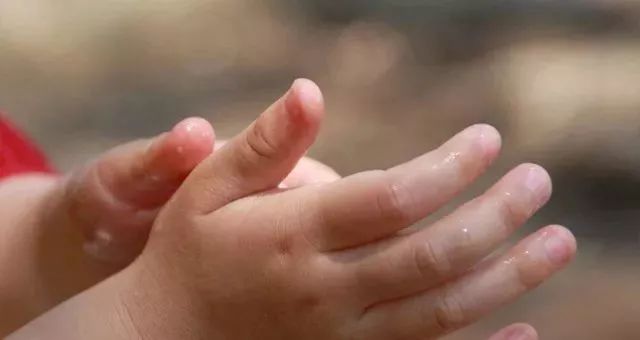 冻疮破皮怎么用十滴水,冻疮裂口抹什么好得快