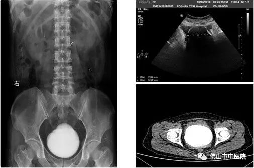 「注意」吓一跳！膀胱结石拳头大，异常信号早警惕
