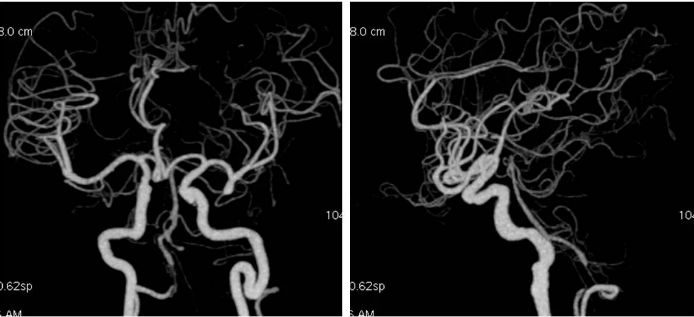 椎动脉起始段狭窄的介入治疗ppt,椎动脉v4段假性动脉瘤介入治疗