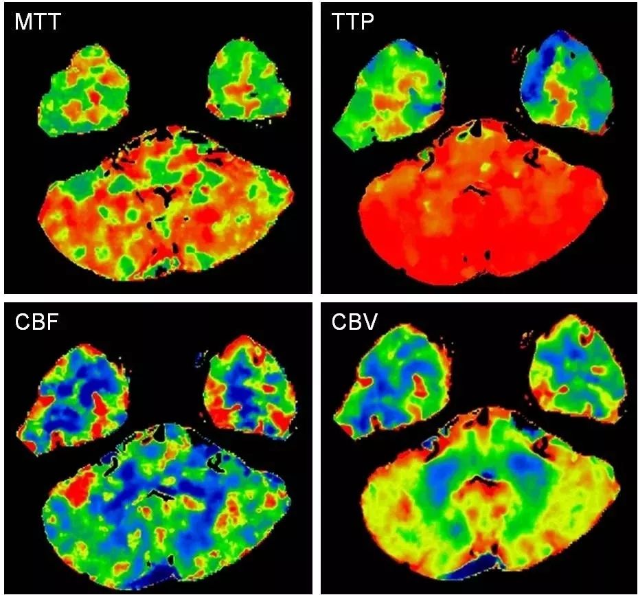 椎动脉起始段狭窄的介入治疗ppt,椎动脉v4段假性动脉瘤介入治疗