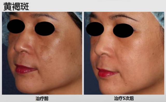 ‘斑’弄是非，超皮秒要你好看