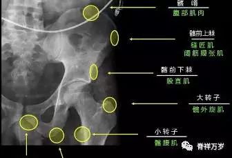 肩关节脱位易漏诊的骨折,放射科容易漏诊的骨折