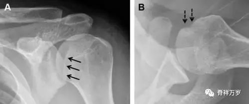 肩关节脱位易漏诊的骨折,放射科容易漏诊的骨折