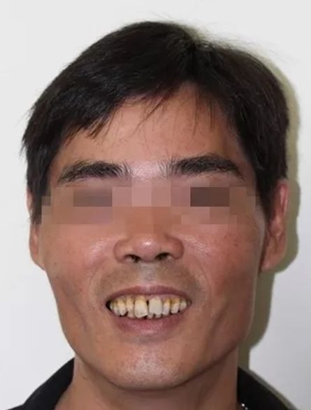 哪十家医院种植牙享受补贴,缺牙市民可申请免费种牙