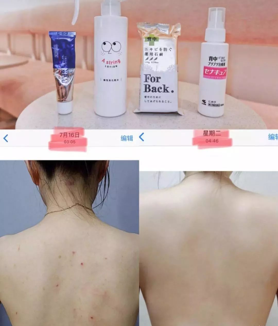 红肿,流脓的万年毒痘一喷全消失?岛国新晋痘肌终结者!彻底祛痘不反复!