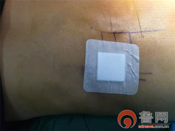 射频靶点热凝术治疗腰椎间盘突出,硬膜外腔注射治疗腰椎间盘突出症