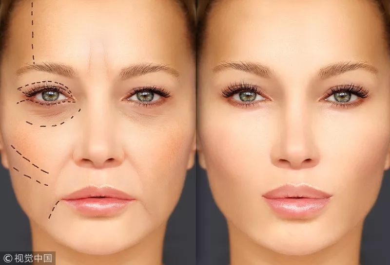 去掉眼袋之后天壤之别,无美颜无滤镜遮泪沟眼袋