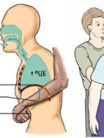 喉咙总感觉有异物卡住是什么原因,喉咙卡住异物正确的做法