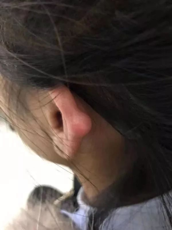 打耳洞耳软骨瘤,软骨打耳洞增生怎么办