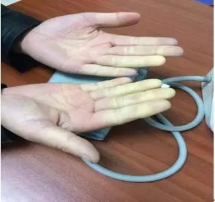 什么症状要看风湿免疫科,风湿免疫性疾病有哪些症状