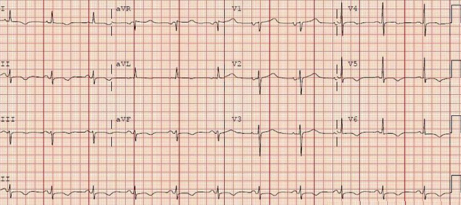 干货：急性心包炎的临床诊疗要点