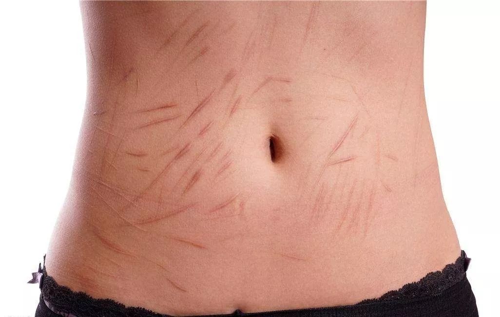 超脉冲co2点阵激光一次多少钱,点阵激光对修复疤痕是一把利剑