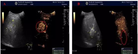 微波消融术能治多大肿瘤,微波射频消融术治疗肿瘤