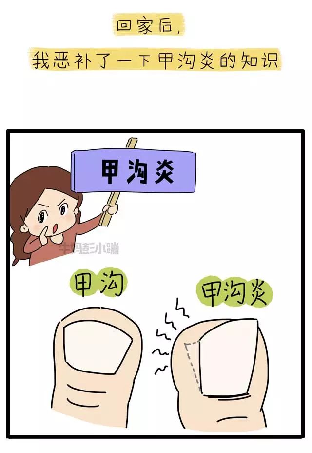 撕倒刺指甲化脓掉了,拔倒刺后指甲脱落