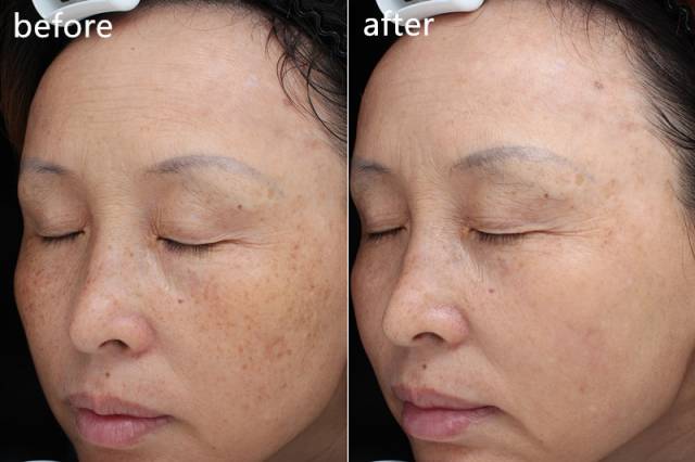 ‘斑’弄是非，超皮秒要你好看