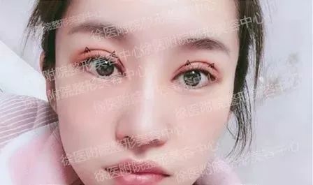 双眼皮失败又不想修复怎么办,双眼皮失败修复方法如下
