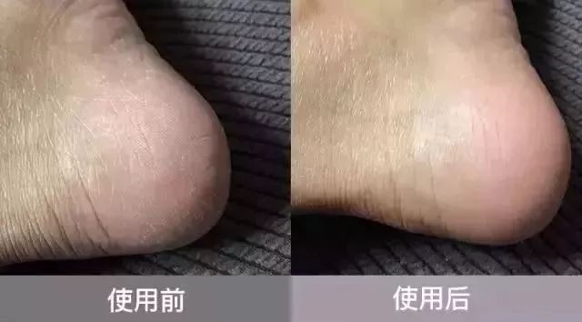 脚后跟干裂修复霜去死皮,脚干裂脱皮修复霜