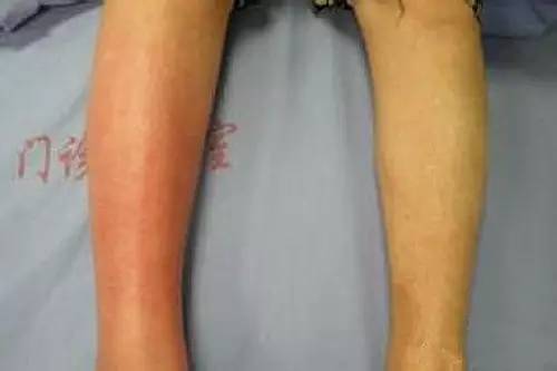 暴雨天出门，江西男子染上这种病！医生提醒：严重可致命