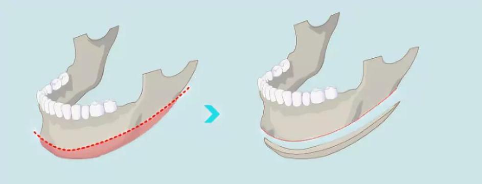 整容315事件真实案例,整容毁容真实案例如何赔偿
