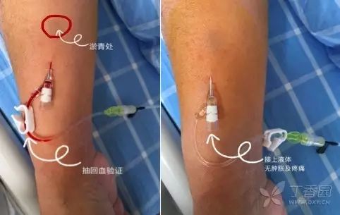 针拔出来血管就可以愈合吗,拔针把血管戳破了咋办