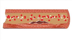 血管堵演示,血管堵塞100张图片