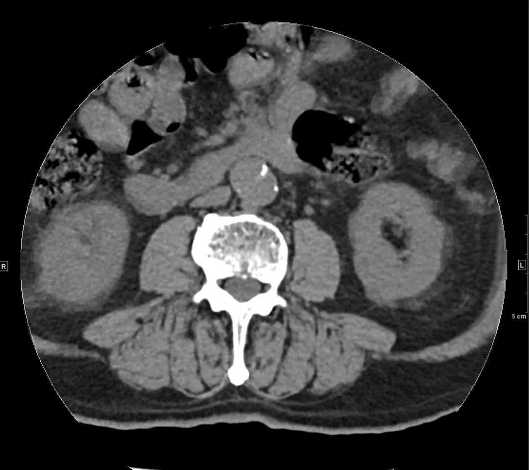 心冠动脉夹层能治愈吗,夹层动脉血管破裂症状