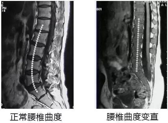 久坐相当“慢性自杀”！德国骨科专家打造的“撑腰”神器，坐9小时腰也不痛，20年颈脊椎病都好了