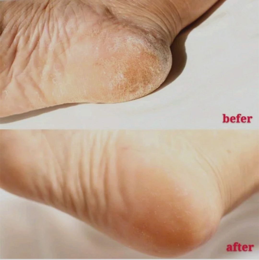 每天成交2w单!连穿7天不臭脚的袜子,世界专利金奖,连脚气都没复发了!