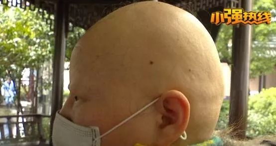 头发睫毛眉毛全部掉光能不能治好,头发睫毛眉毛全部掉光有没有案例