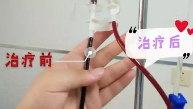 “洗血”疗法是什么鬼？减肥排毒还改善皮肤？这种医美太可怕……