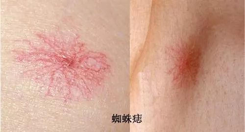 肝癌早期有三颗痣图片,红色痣肝癌的前兆