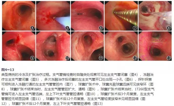 球囊扩张治疗狭窄,支气管结核冷冻术