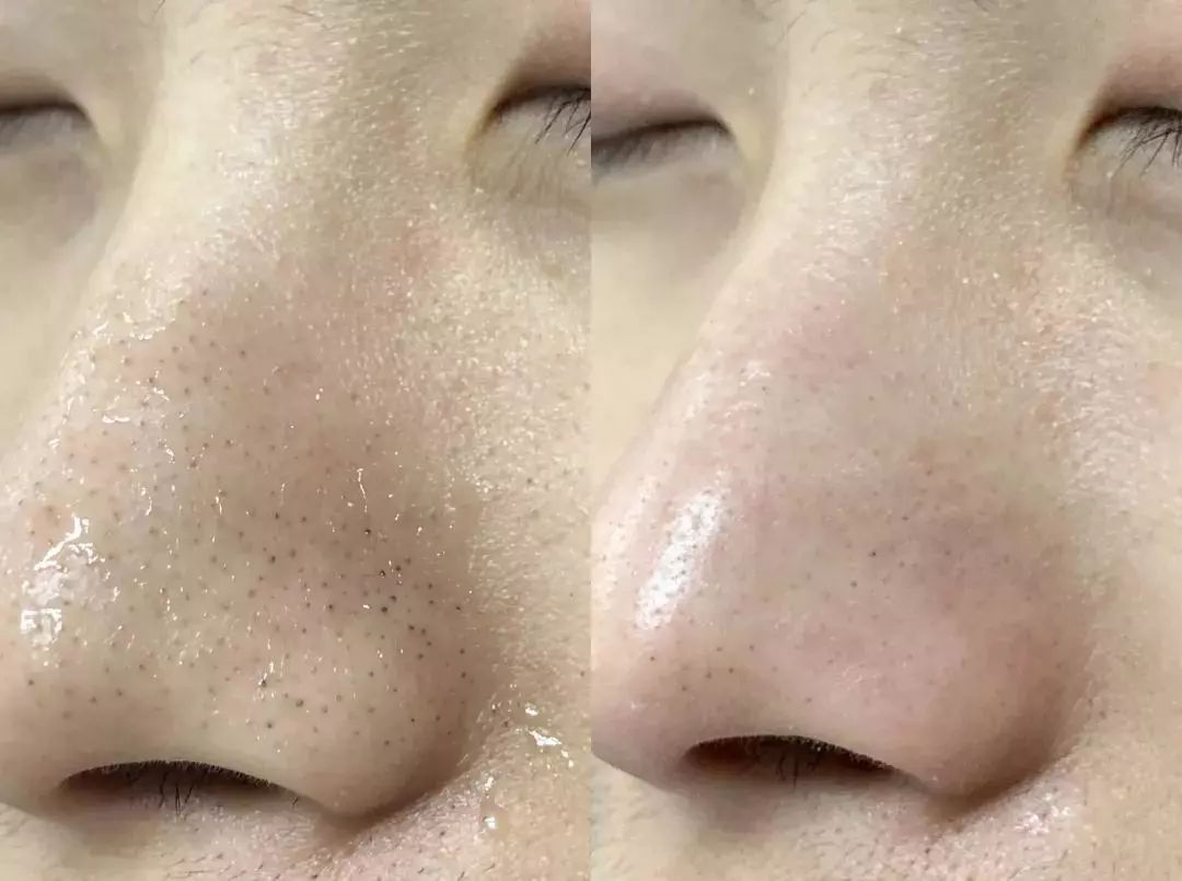 怎么把脸上的黑头清掉,去黑头推荐全脸