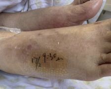 热水袋烧伤,热水袋烧伤起泡怎么处理