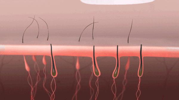 10分钟永久全身脱毛，给你一个滑溜溜的夏天