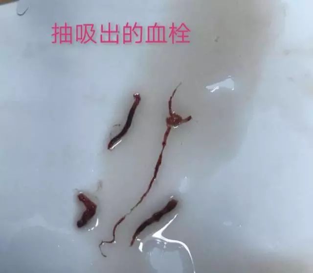 急性心肌梗死院前急救的急救措施,中医治疗急性心肌梗死的急救方法