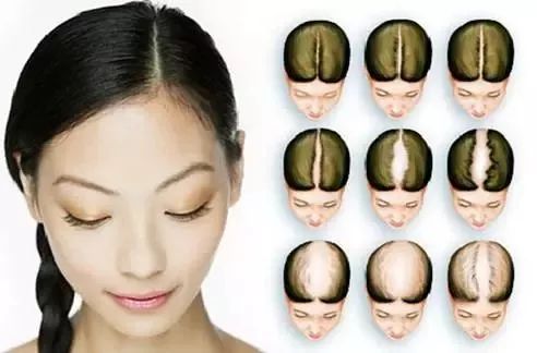 预防脱发和让头发变多的方法,春季脱发吃什么好得快