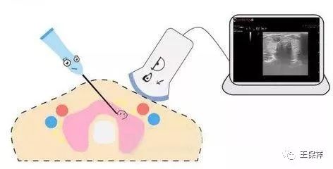 体检发现甲状腺结节应该查什么,体检报告甲状腺结节怎么回事