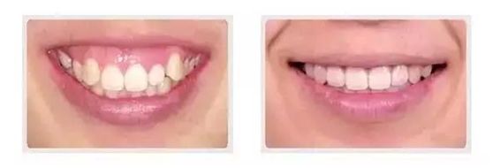 外用涂抹式肉毒素可以祛皱纹吗,去皱纹的肉毒素一年打几次为佳