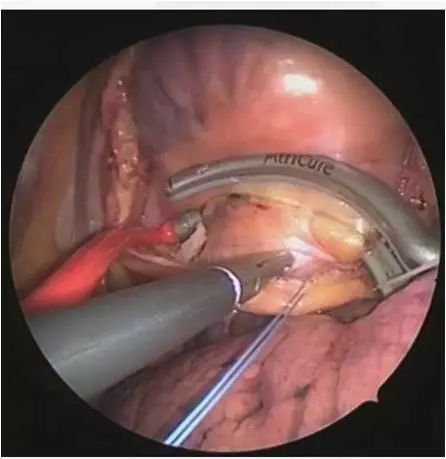 专家讲房颤治疗方法,专家医生谈房颤