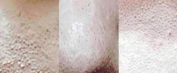 用了几天火山泥为什么还毛孔粗大,怎样用韩国进口火山泥洗脸