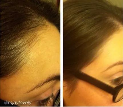 发际线防脱发神器,增发神器发际线