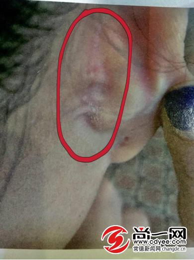 4万元隆鼻手术后续,隆鼻手术近万元术后半月