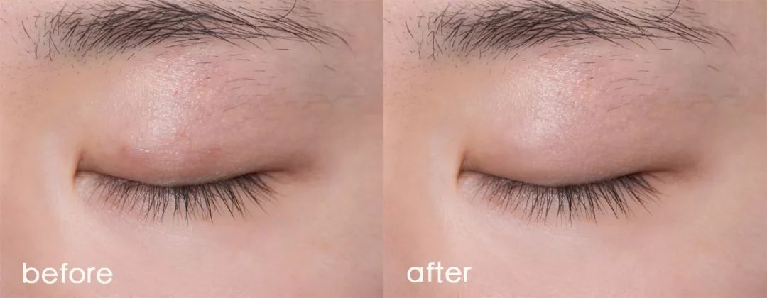 埋线双眼皮分叉修护动作,双眼皮埋线术后注意事项大全