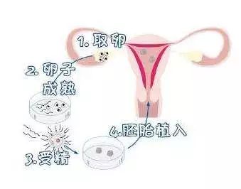 疼痛？渗液？全方位解析取卵术！