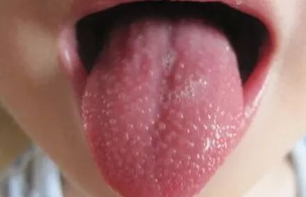 春天幼儿出疹怎么治,孩子出疹与季节有关的情况