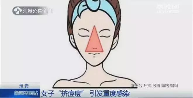 女子挤痘痘致感染被送急诊,女子挤痘痘进icu